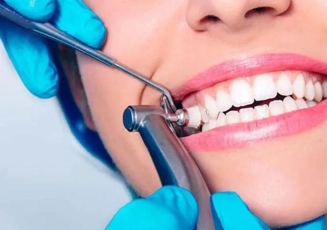 How Much Does Teeth Scaling and Polishing Cost?