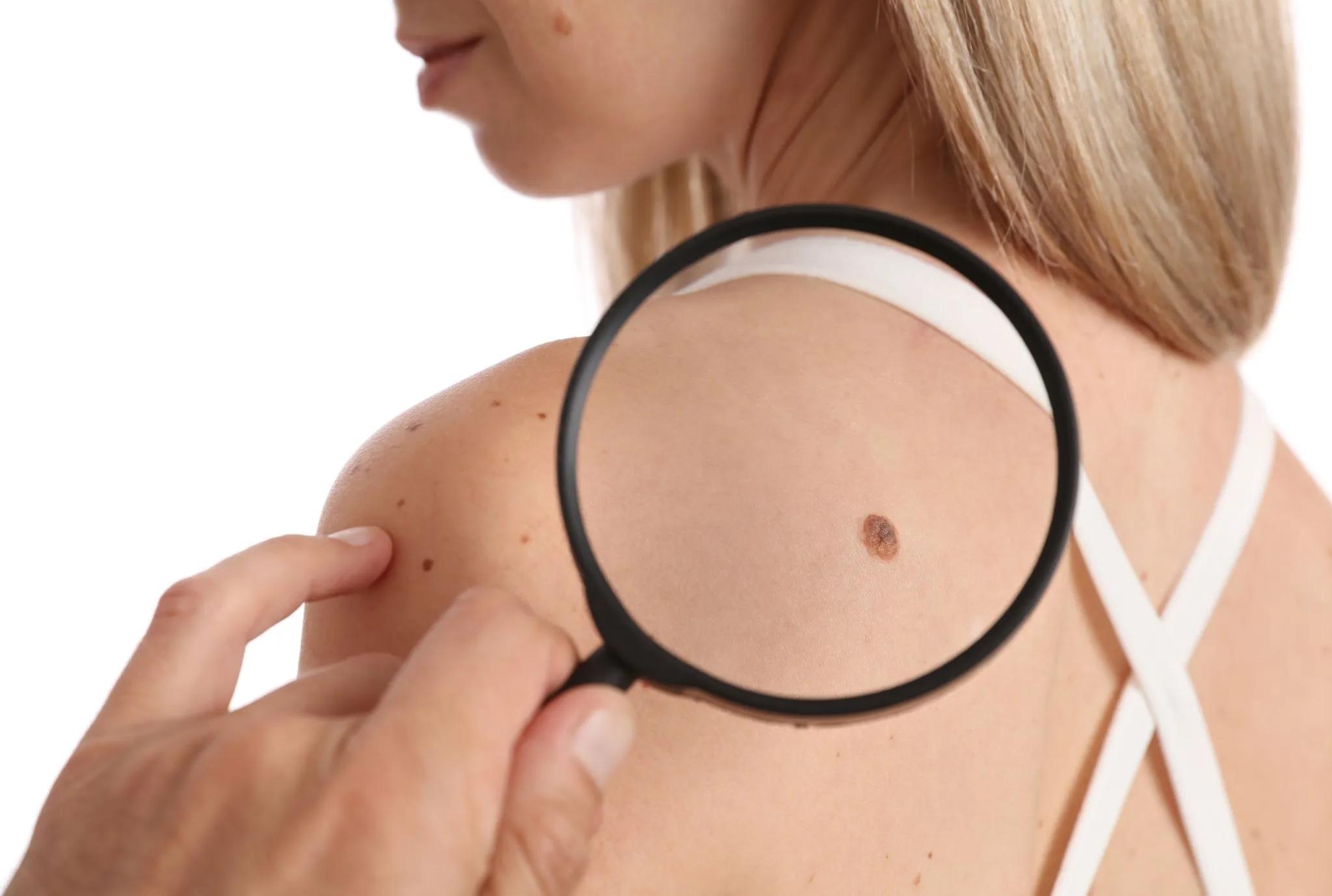 Are Skin Tag Removal Treatments FDA Approved?