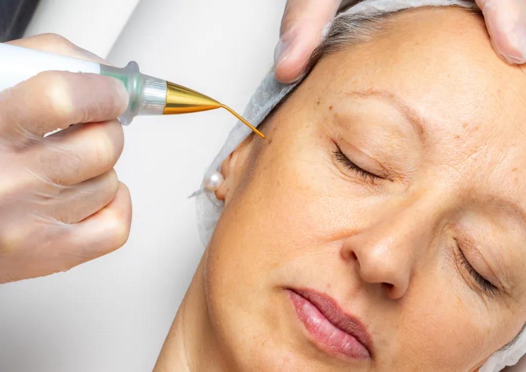Is Plasma Pen Treatment Suitable for All Skin Types?